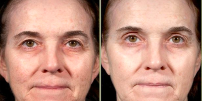 Woman treated with Pearl Laser - Pearl Laser