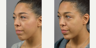 Moman treated with Chin Filler - Facial Asymmetry and contour is natural and makes each face unique. While most imperfections go unnoticed by the outside world. Often times we treat with surgical interventions but for a temporary adustment with just as much impact the use of Botox and Filler can be used. Non-surgical Rhinoplasty by Dr. James Marotta complimented by filler injections to the chin.