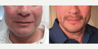 35-44 year old man treated with Dimpleplasty - 35-44 year old man treated with Dimpleplasty