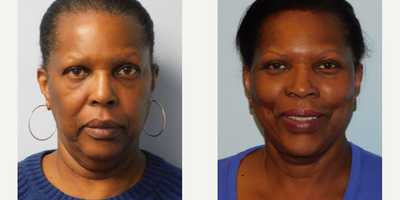 Woman treated with Mini Facelift - Before and after mini-facelift. Post-op photos were taken at 6 months.