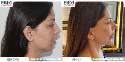 45-54 year old woman treated with Facelift, Mini Neck Lift - 45-54 year old woman treated with Facelift