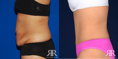 Tummy Tuck - Tummy Tuck