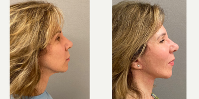 55-64 year old woman treated with Facelift, SMAS Facelift, Neck Lift, Facelift Revision - 62 yo s/p secondary facelift in our on site AAAA certified operating suite under local anesthesia with sedation.