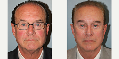 64 year old man treated with Lifestyle Lift - Unhappy with the signs of facial aging, this 68-year-old man sought out facial plastic surgery specialist. His signature LiteLift, modified facelift, was performed along with a neck lift, brow lift, upper and lower eyelid surgery and rhinoplasty to improve his overall facial features. All procedures were performed in a conservative manner to maintain a natural result under general anesthesia . Notice his refreshed appearance in his post-op pictures. After photos were taken 1-year post-op.