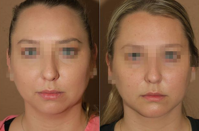 Woman treated with Chin Implant - Woman treated with Chin Silicone Implant (done from inside of the mouth so there is no external scar)
