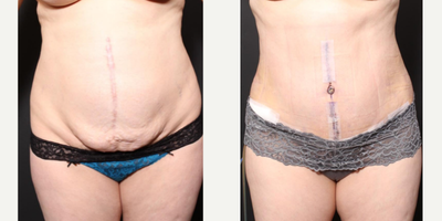 25-34 year old woman treated with Umbilical Hernia Repair - This patient from out of state had prior abdominal reconstruction that resulted in a handful of problems including residual hernia, pain, loss of the belly button, and loose skin. To help, we performed a ventral hernia repair, scar tissue removal, skin excess removal, and the creation of a new belly button.