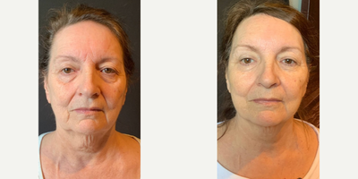 Woman treated with Thread Lift - Woman treated with Thread Lift forbrows, cheeks and jowls as well asDysport forglabella and platelet rich plasma. No dermal filler was used.