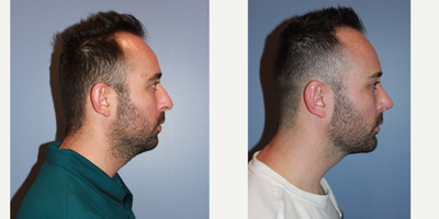 25-34 year old man treated with Rhinoplasty - Rhinoplasty, Chin Augmentation, Otoplasty
