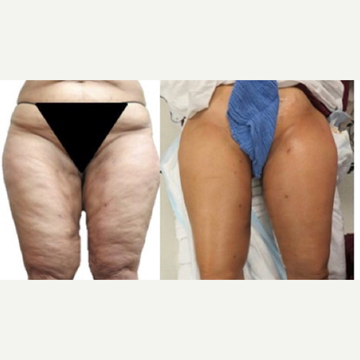 55-64 year old woman treated with Thigh Lift - A thigh lift can tighten sagging skin to create smoother, firmer, more youthful- looking thighs. This 56-year-old turned back the hands of times by undergoing a thigh lift with Dr. Elie Levine, right in time for bikini season!