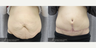 18-24 year old woman treated with Panniculectomy - Panniculectomy  20 Year Old Female