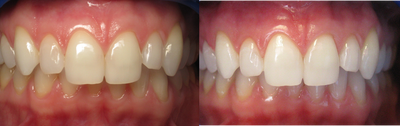 Before and after teeth whitening - 
	Patient had BriteSmile teeth whitening treatment to improve the appearance of her smile.
