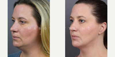 Woman treated with Chin Liposuction - Submental Liposuction with Renuvion. Swipe left to witness the stunning before-and-after photos of our satisfied patient! Our patient underwent submental liposuction, a minimally invasive procedure targeting excess fat beneath the chin. But thats not all  we took it a step further with Renuvion, a cutting-edge technology for skin tightening.