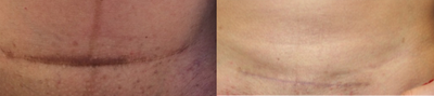 35-44 year old woman treated with Scar Removal - c-section scar revision and Embrace therapy 6 months post op