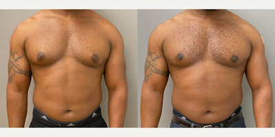 35-44 year old man treated with Gynecomastia Surgery - 36 yo s/p male breast reduction performed under local anesthesia with sedation in our on site AAAA certified operating suite.