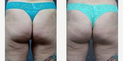 Woman treated with Qwo - These photos are after 3 Qwo treatments