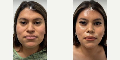 Woman treated with Jaw Reduction - Woman treated with Facial Feminization Surgery through coronal approach to a brow bone and supraorbital bone reduction, a direct Brow Lift, Neck Lift, Facelift, Jaw Reduction, T Genioplasty, Buccal Fat Removal, and a closed Rhinoplasty. Patient is shown before and 6 months post-op.