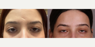 Woman treated with Scar Removal - Scar revision surgery involves meticulous planning and yes, the scar can be faded to a level where it is imperceptible to people.Sometimes after scar revision, other treatments such as microneedling, laser etc can be added to further improve the results.But if there is an underlying structural defect, then surgery is the first step.