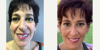 45-54 year old woman treated with ALMI fat transfer to face - Full face fat transfer with ALMI/SCEFI fat transfer to temples, tear troughs, cheeks, nasal labial folds and marionette lines. H. William Song, MD Oakland NJ