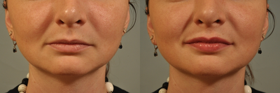 Lip Injection -
This patient received a lip filler in her top and bottom lips to gain a fuller appearance.