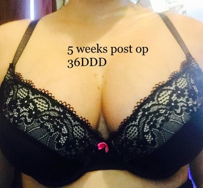 5 Foot 125 Pounds 34B to 34DDD - Review - RealSelf