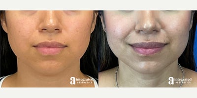 35-44 year old woman treated with AccuTite - The patient is a 38-year-old female who had concerns with the appearance of her lower face and neck. Dr. Cho performed accutite to the lower face and neck. After photos are 1 year post procedure.