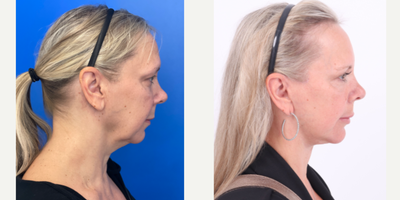 55-64 year old woman treated with Facelift, Neck Lift, Eyelid Surgery, Facial Fat Transfer - 57 year old 1 year after Facelift, Neck lift, Upper Eyelid Blepharoplasty and Facial Fat transfer with Dr. Madnani
