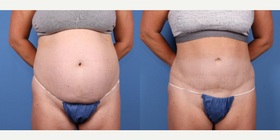 45-54 year old woman treated with Tummy Tuck, Drainless Tummy Tuck, Power-Assisted Liposuction (PAL) - liposuction of abdomen, waist, love handles with abdominoplasty