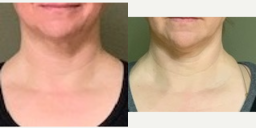 45-54 year old woman treated with truSculpt iD - Neck trusculpt id