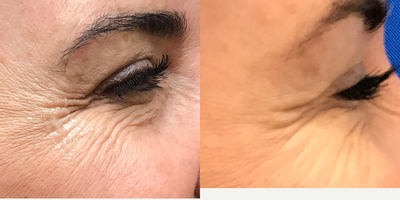 45-54 year old woman treated with Botox - Light dose of botox to give a natural yet soft look!