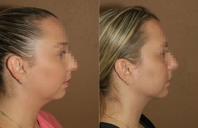 Woman treated with Laser Liposuction - Woman treated with Laser Liposuction of the neck