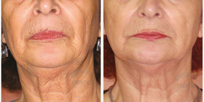 55-64 year old woman treated with EndyMed 3Deep - Before and after of our new treatment EndyMed. One of the treatments that uses this innovative radio frequency technology is FSR (Fractional Skin Resurfacing) which can have incredible results like this by fine lines and wrinkles by smoothing and tightening the skin.