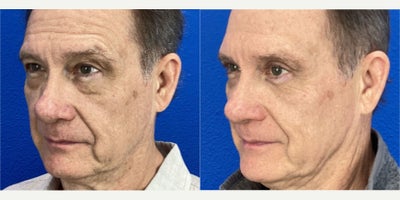 55-64 year old man treated with Eyelid Surgery, Double Eyelid Surgery - 55-64 year old man treated with Double Eyelid Surgery, Eyelid Surgery