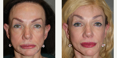 Woman treated with Eyelid Surgery - Eyelid Lift