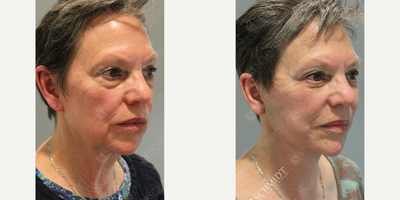 Woman treated with Neck Lift - Neck Lift
