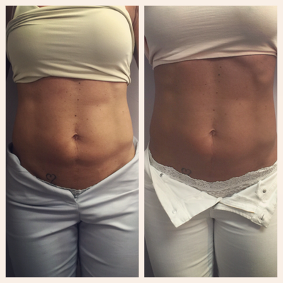 Kybella treatment to abdomen - We have an incredibly fit woman who has the ability to lose excess belly fat, though does not like to lean down to her lowest weight for sake of losing her overall softness and femininity. Instead, we feathered one vial of Kybella using a microcannula to the small fat deposit below her belly button. On the left, before treatment. On the right, 4 weeks post treatment.