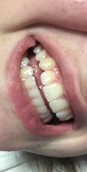 wearing retainer after teeth have shifted
