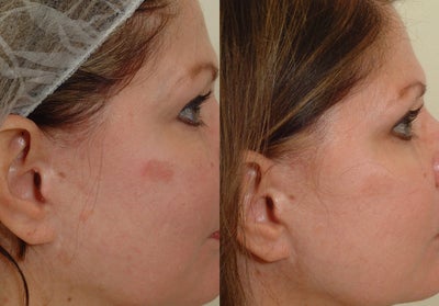 Pearl laser - 
	Pearl laser-two treatments
