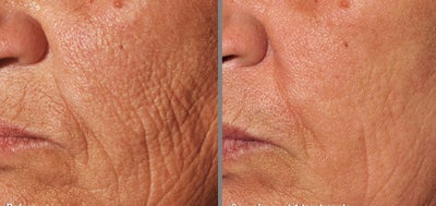 Pearl & Pearl Fractional - texture, pigmentation and wrinkles