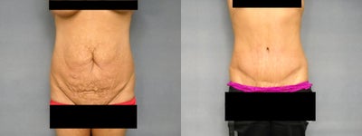 Age: 50, Hieght: 54, Weight: 149lbs. -
1486 grams removed.