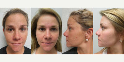 25-34 year old woman treated with BroadBand Light (BBL) - 25-34 year old woman treated with BroadBand Light (BBL)