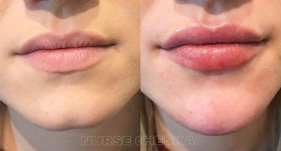 18-24 year old woman treated with Teosyal - Lips Augmentation