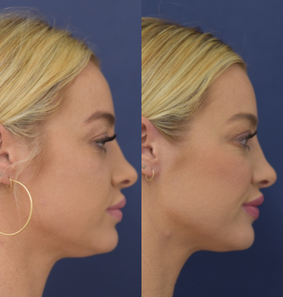 25-34 year old woman treated with Voluma - Facial contouring using Voluma XC to enhance the cheekbones, jawline, and chin.