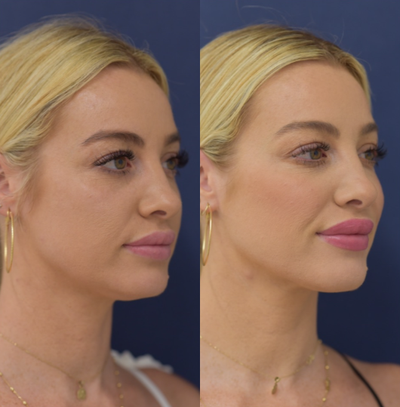 25-34 year old woman treated with Voluma - Facial contouring using Voluma XC to enhance the cheekbones, jawline, and chin.
