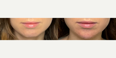 35-44 year old woman treated with Chin Filler - Chin filler, immediately after injection, a natural enhancement.