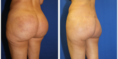 45-54 year old woman treated with Silicone Injection Removal - This patient who had undergone raw silicone injections was experiencing chronic lower back pain, buttocks pain, and leg pain due to the raw silicone injections. She felt as her buttocks was way too big. She was also having pain- to-the-touch and redness of the skin due to the silicone injections. Dr. Katzen removed the raw silicone by making an excision above her buttocks in order to lift her buttocks and locate the raw silicone that had previously been injected. She is extremely happy with her results. Notice how the redness of the skin is gone too now that the raw silicone injections have been removed.