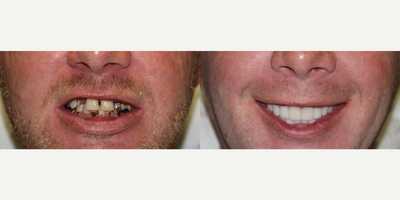 All-on-4 Dental Implants - All-on-4 Dental Implants