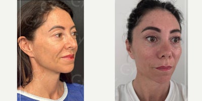 45-54 year old woman treated with Mini Facelift, Lower Facelift, Vampire Facelift - 45-54 year old woman treated with Mini Facelift