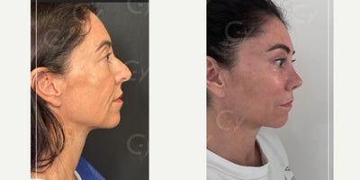 45-54 year old woman treated with Mini Facelift, Lower Facelift, Vampire Facelift - 45-54 year old woman treated with Mini Facelift