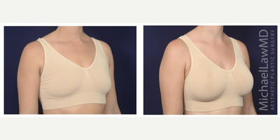 25-34 year old woman treated with Ideal Implant - Breast augmentation. Follow-up photo taken 1 month after the procedure.