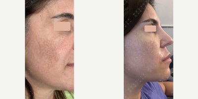 35-44 year old woman treated with Dermapen - She came for skin treatment and otoplasty. Had laser procedure for the face previously but experienced a hyperpigmentation complication. Dermapen, fat grafting, and facial rejuvenation was performed along with use of an exosome cream for a month. Note how the fine wrinkles and the skin tone and skin texture is improved.
